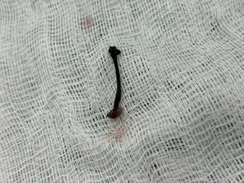 Con vắt sống một tuần trong mũi bé trai 30 tháng tuổi