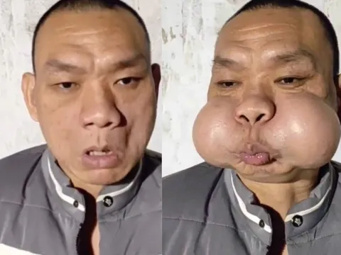 Gương mặt biến dạng của 'hoàng tử ếch' TQ thổi thủy tinh suốt 30 năm