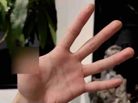 Nuôi rắn độc làm thú cưng, người đàn ông Trung Quốc phải cắt bỏ ngón tay