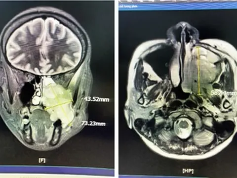 Bỗng phát hiện căn bệnh ung thư quái ác sau khi nghẹt mũi và đau răng