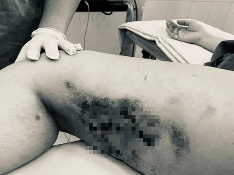 Suýt mất mạmg với “thần dược” tan mỡ ở các cơ sở thẩm mỹ chui